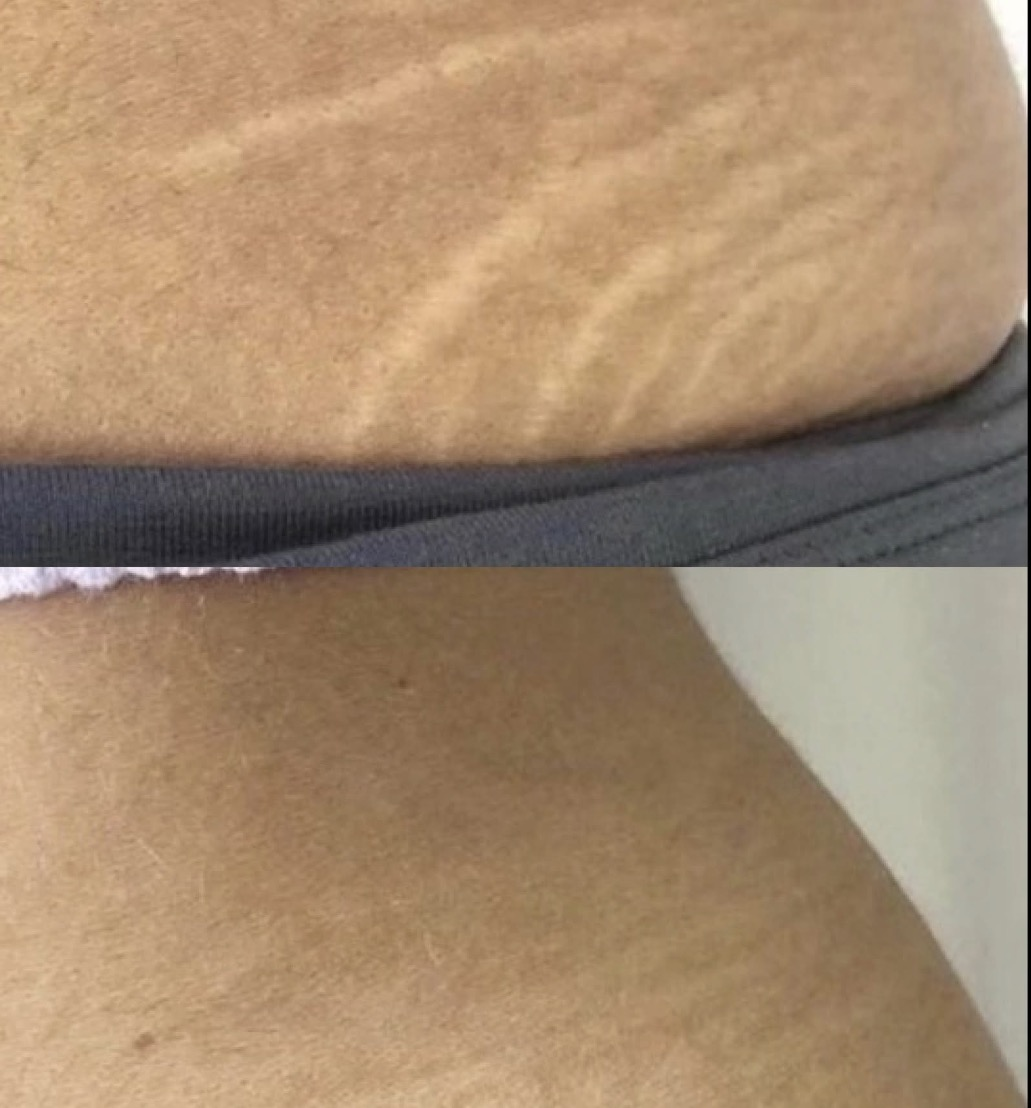 Stretch Mark Camouflage Before & After 1