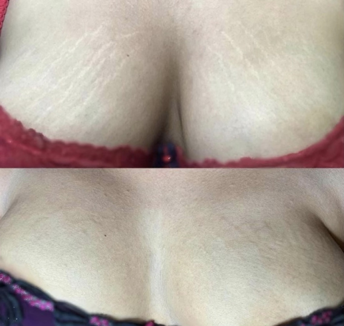 Stretch Mark Camouflage Before & After 2