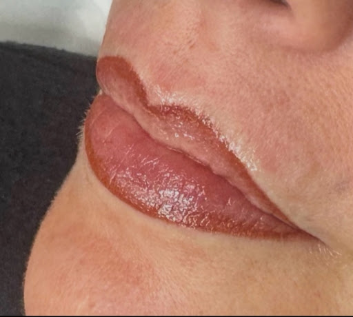 Lip Treatment Result 5