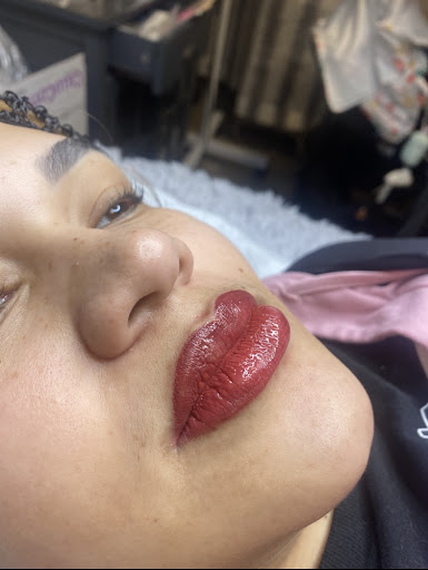 Lip Treatment Result 6