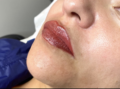 Lip Treatment Result 7